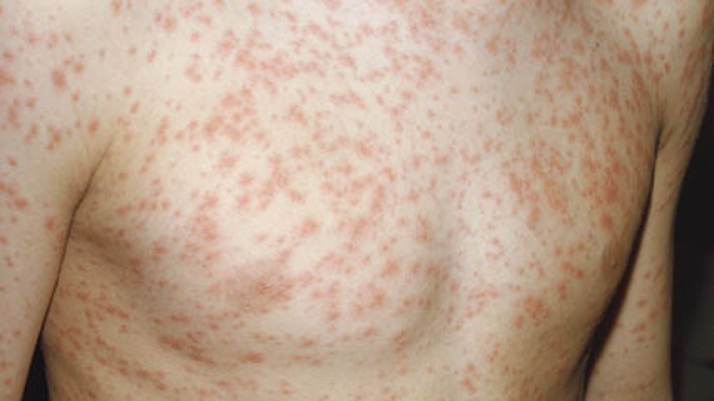 <p>An infectious disease which produces small red spots all over the body - caused by a virus</p>