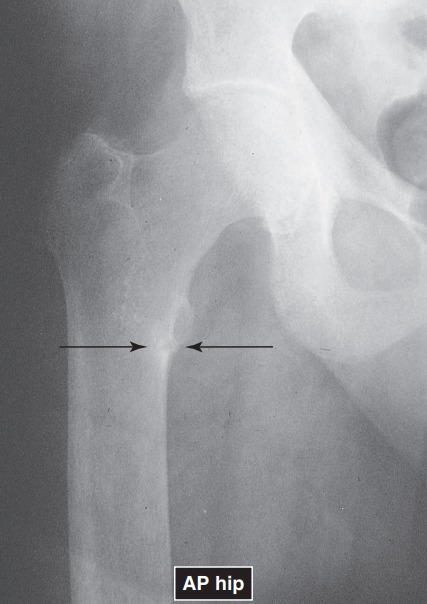 <p>overall decrease in skeletal density</p>