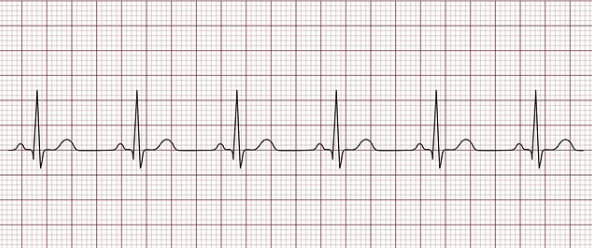 Contains 1 P wave for every QRS complex