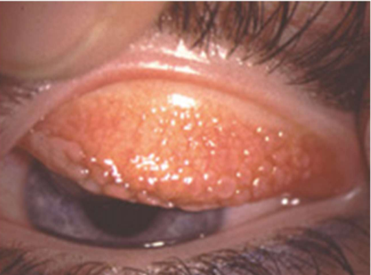 <p>Contact lens induced</p><p>Verneal (seasonal) keratoconjunctivitis</p>