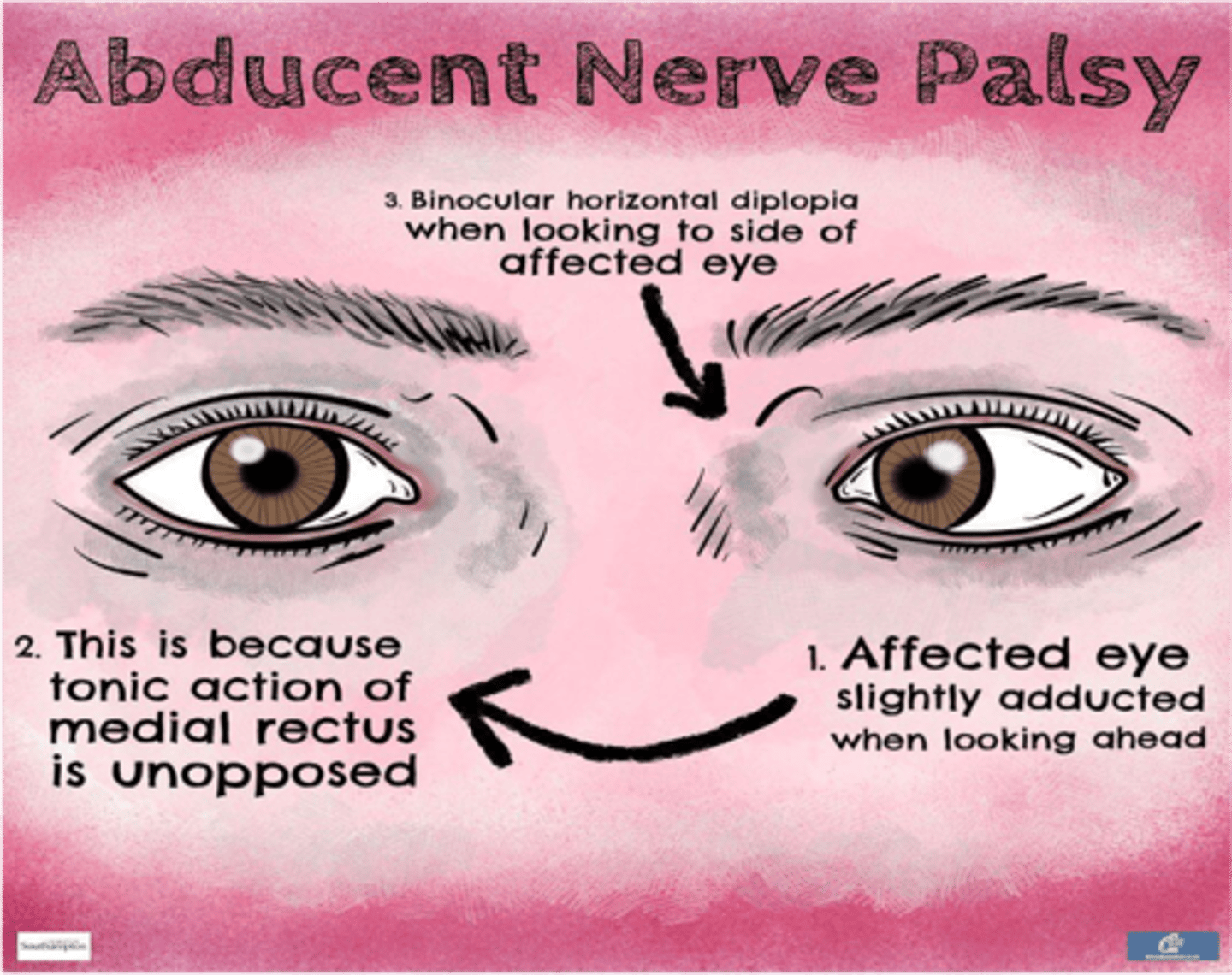 <p>Medial deviation of eyeball (internal strabismus)</p>