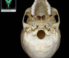 <p>Round hole Superior opening in middle cranial fossa Inferior opening in infratemporal fossa Middle meningeal artery passes through this opening</p>