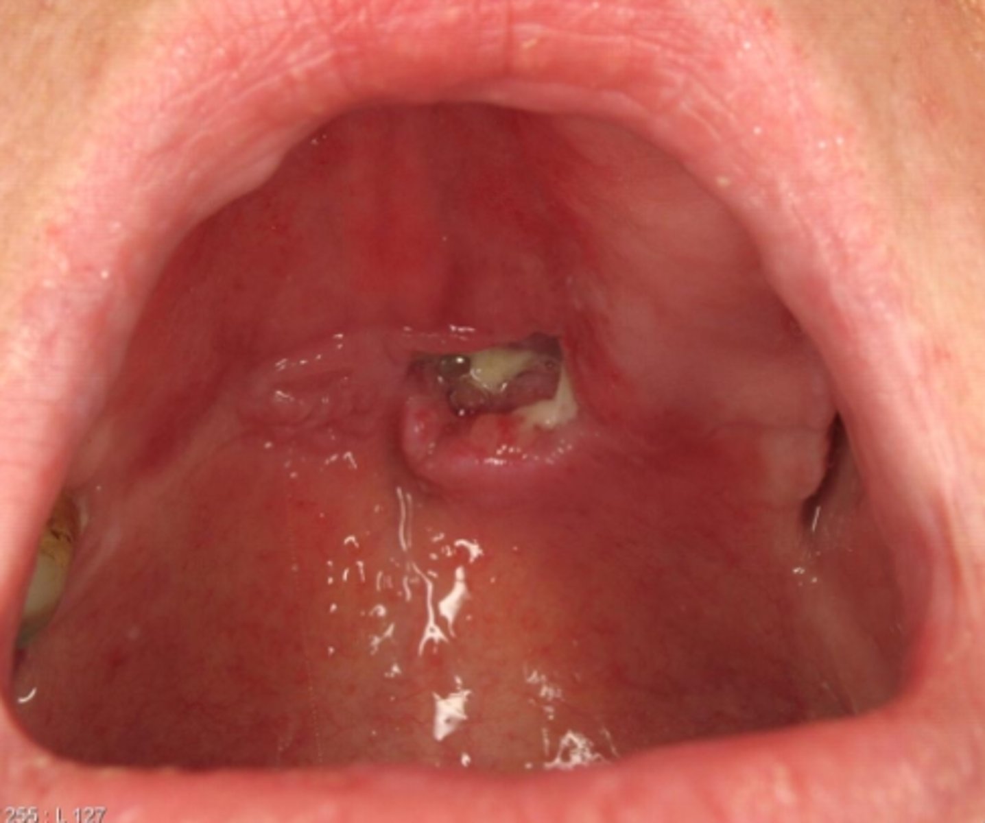 <p>necrotizing sialometaplasia</p>