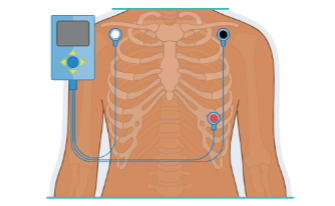 <p>Three-lead EKG</p>