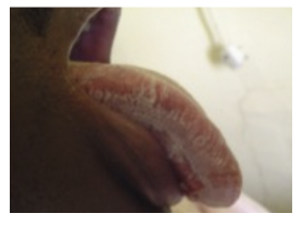 <ul><li><p><span><strong>An African American male presents with a non-scrapable plaque on his tongue. He has a history of injection drug use and currently uses IV heroin 3-4 times a week. No medical records and no immunization history known. CD4+ count is 410/mm3. This patient’s condition is most likely caused by?&nbsp;</strong></span></p><ul><li><p><span>Candida albicans&nbsp;</span></p></li><li><p><span>C. diphtheriae&nbsp;</span></p></li><li><p><span>Cytomegalovirus&nbsp;</span></p></li><li><p><span>EBV&nbsp;</span></p></li><li><p><span>HHV-8</span></p></li></ul></li></ul><p></p>