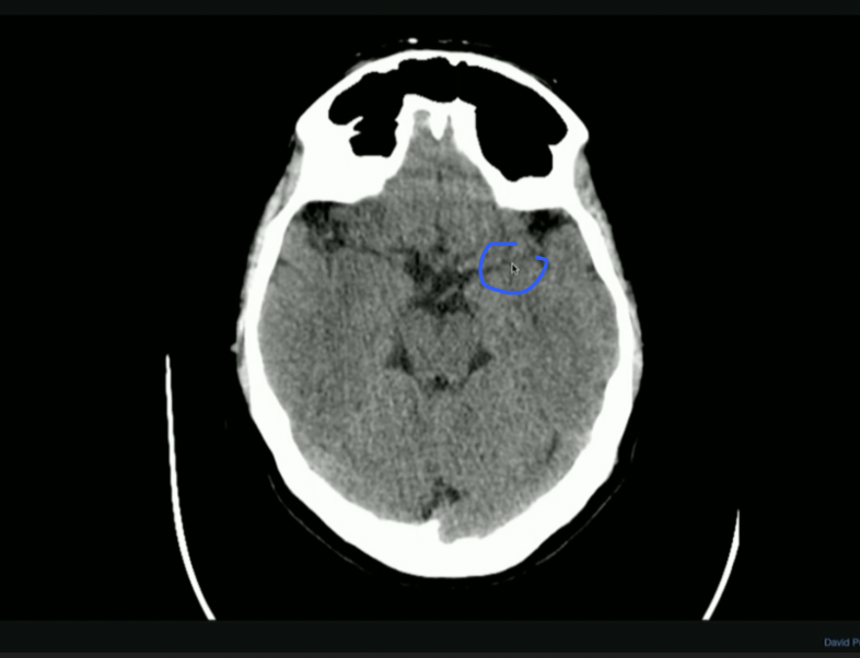 <p>What Fissure is this?</p>