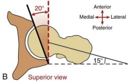 <p>known as the acetabular anteversion/retroversion angle </p><p>amount of anterior or posterior orientation in the transverse plane</p><p>Normal ~20 degrees anteversion </p><p>>20 degrees is anterversion, <20 is retroversion </p>