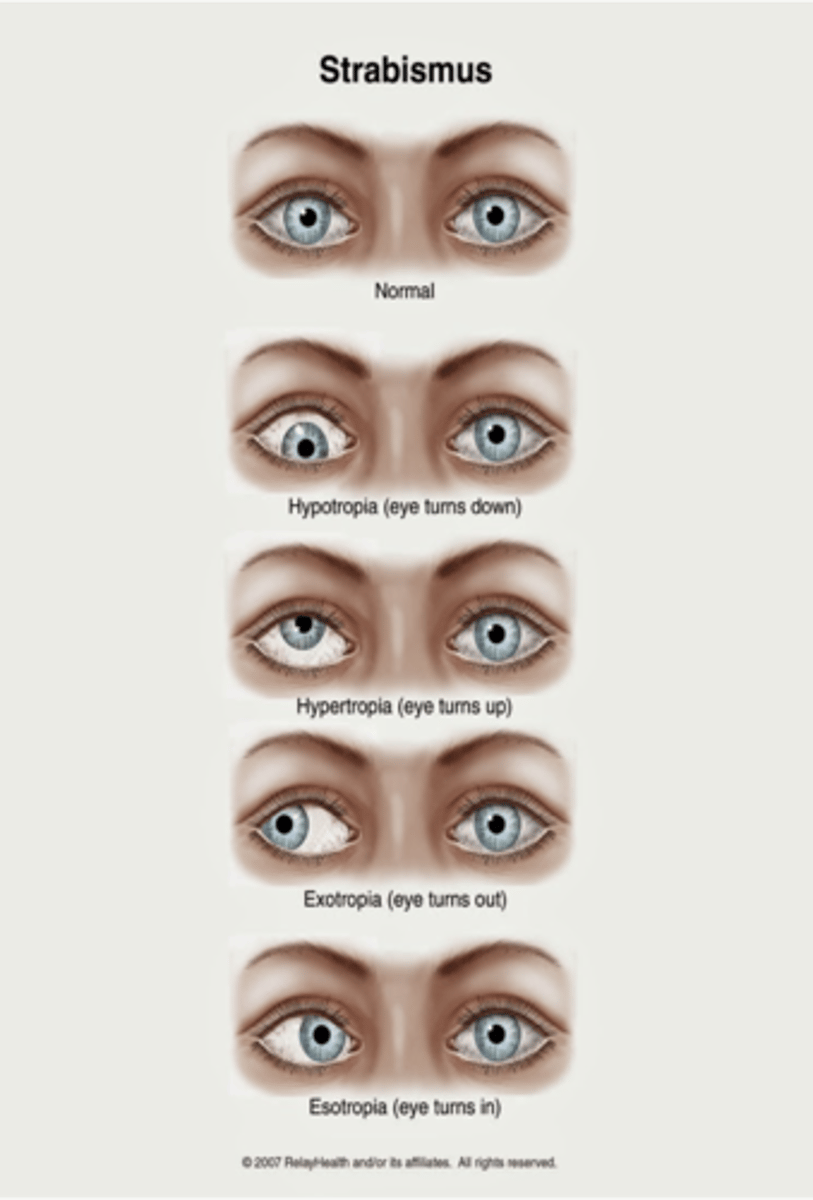 <p>Outward alignment (tropias are constant)</p>