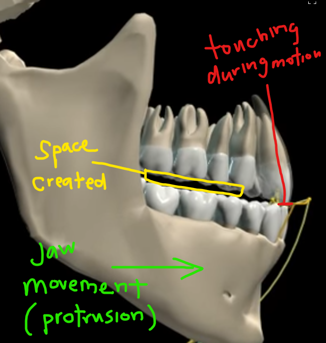 <p>When mandible moves forward from centric occlusion. </p><ul><li><p><strong>Only</strong> teeth touching are the 4 anterior teeth (possibly canines) </p><ul><li><p>NO POSTERIOR TEETH TOUCH </p></li></ul></li></ul><p></p>