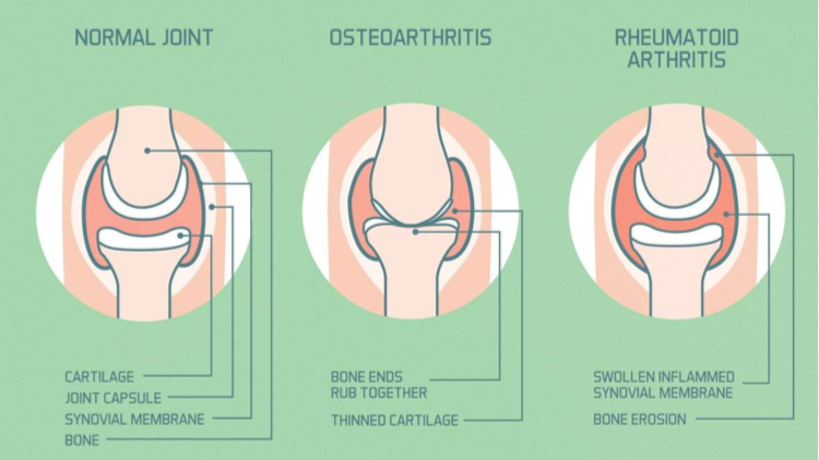osteoarthritis (OA)