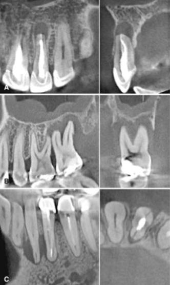 <p>Intraoral radiographs should be considered the modality of choice because there are indications for limited field of view in CBCT</p>