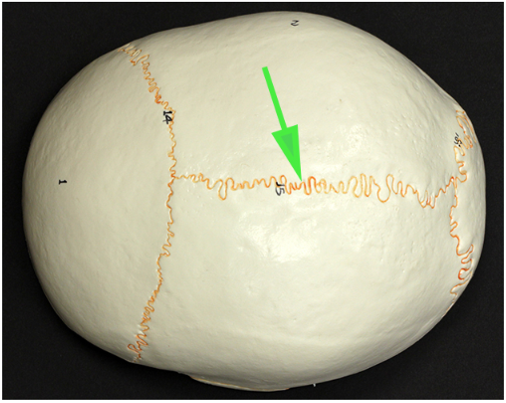 <p>What is the suture marked by the green arrow?</p>