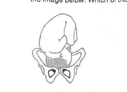 <p>What is a correct description for the fetal position shown?</p>