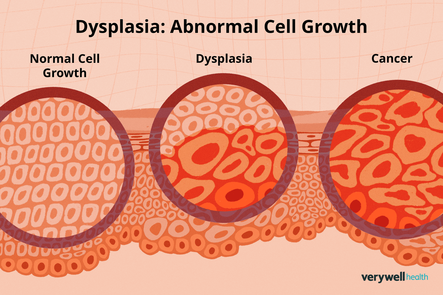<p>Essentially when there is the presence of <strong>abnormal cells</strong> within a tissue/organ. </p><ul><li><p>It is when <strong>cells change in shape and organization. </strong></p></li><li><p>Considered the <strong>early stage of neoplasia (tumor formation)</strong></p></li><li><p>Can develop into cancer if left untreated <span data-name="frowning_face" data-type="emoji">☹</span> </p></li></ul><p></p>