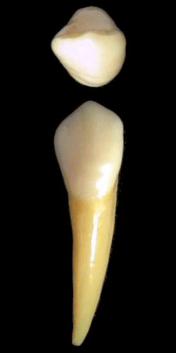 <p>what tooth is this &amp; why?</p>