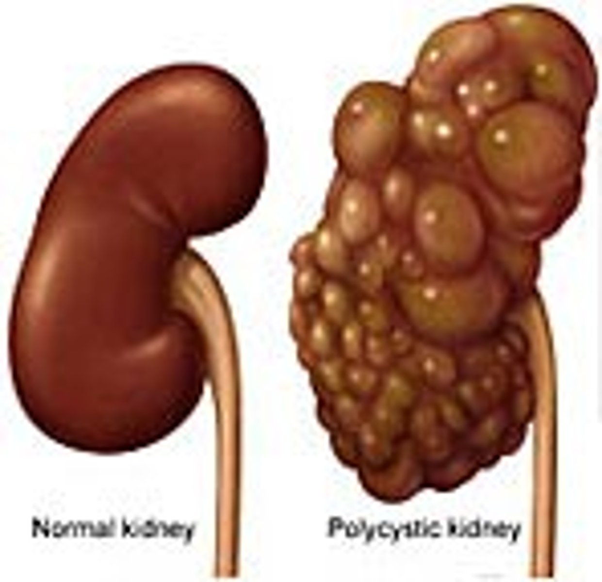 <p>Enlarged with hydronephrosis, cyst, or neoplasm.</p><p>May be difficult to distinguish an enlarged kidney from an enlarged spleen because they have a similar shape. Both extend forward and down. However, the spleen may have a sharp edge, whereas the kidney never does. The spleen retains the splenic notch, whereas the kidney has no palpable notch. Percussion over the spleen is dull, whereas over the kidney it is tympanitic because of the overriding bowel.</p>