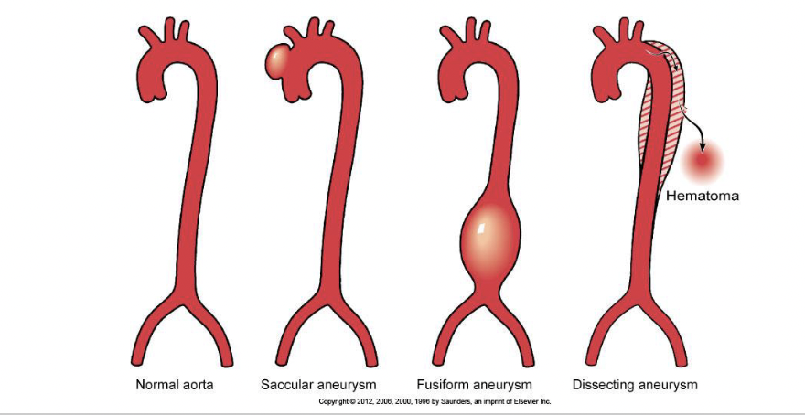 <ul><li><p>can occur in any part of aorta but are most often located in the abdominal aorta and may occur in several forms</p></li><li><p>dilations of the aortic lumen associated with changes in the wall, most often complicating advanced atherosclerosis</p></li><li><p><strong>clinically silent</strong></p></li></ul><p></p>