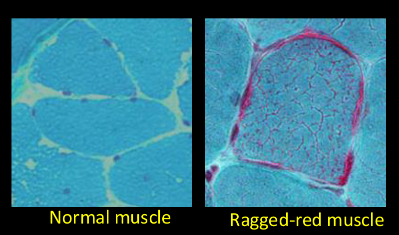 <p>-tRNA mutation results in inefficient protein assembly and ultimately inefficient respiration</p><p>-would be lethal without heteroplasmy</p><p>-because brain uses so much energy, it is most strongly impacted</p><p>-ragged red appearance caused by aggregatoin of mutant mitochondria at the plasma membrane</p>