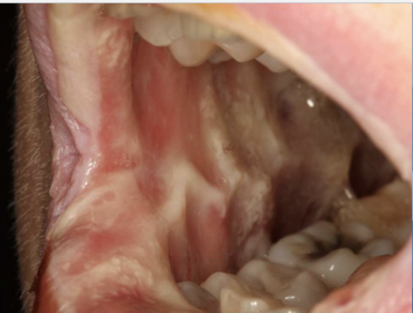 <p>Patient is has breast cancer and is currently on chemotherapy. What do you suspect?</p>