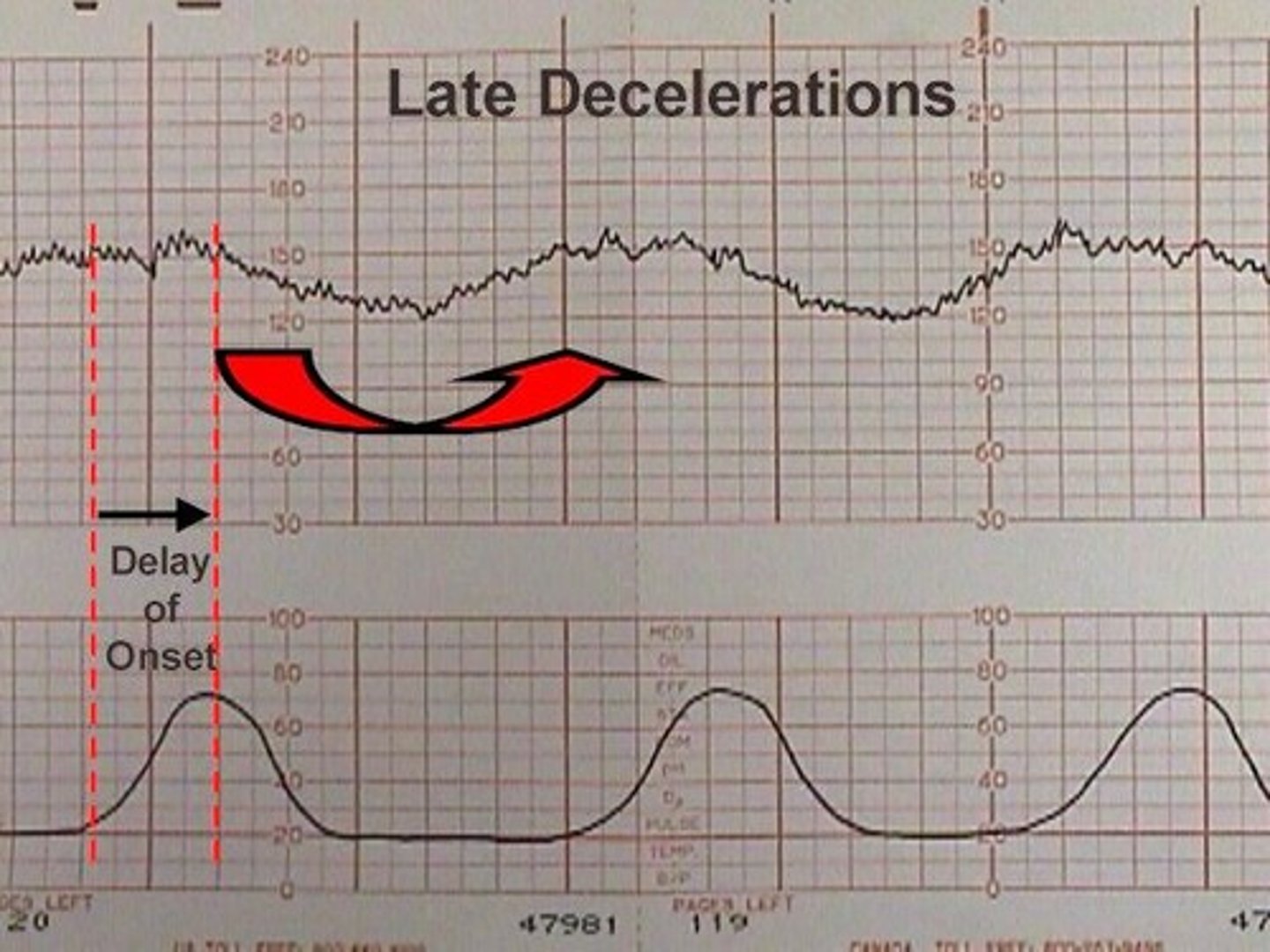 <p>decel: gradual onset &gt;30 sec w/ nadir occurring after peak of ctx; associated w/ placental insufficiency</p>