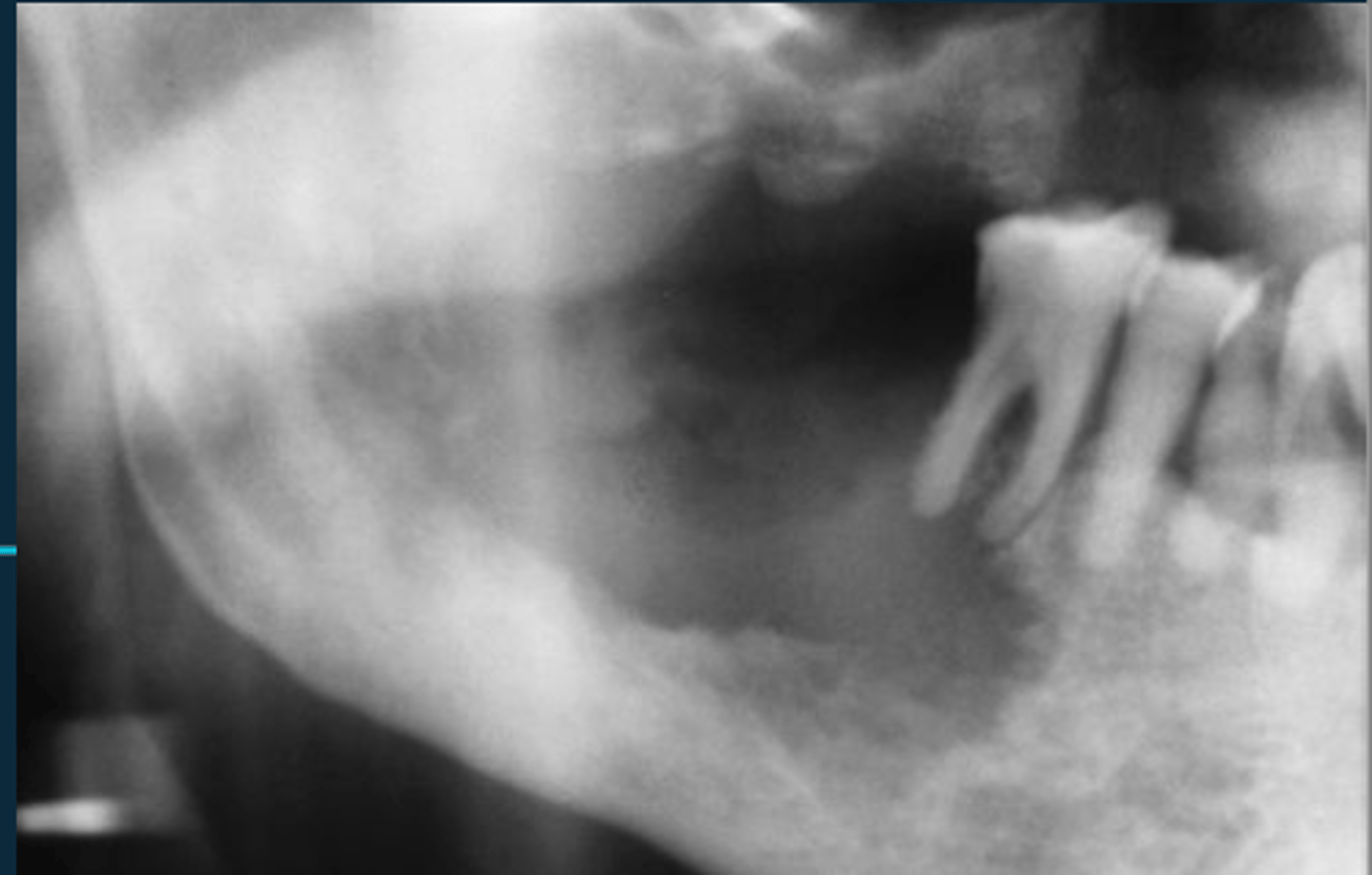 <p>What are some malignant radiographic characteristics?</p>