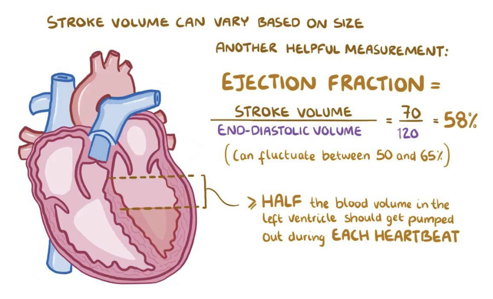 <p>Recognized as a clinical syndrome characterized by signs and symptoms of fluid overload or of inadequate tissue perfusion → caused when heart cannot generate a cardiac output sufficient to meet the body’s demands</p><ul><li><p>systolic failure - heart is not a sufficient pump - weakened heart muscle (HFrEF) <40%</p></li></ul><p> diastolic failure - heart is not getting blood back efficiently - stiff not complient heart muscles (HFpEF)>50%</p><ul><li><p>Normal ejection fraction: 50-70% total amount of blood pumped with each heartbeat</p></li><li><p><span style="background-color: transparent;"><strong>HF with Mildly Reduced EF (41–49%)</strong></span></p></li><li><p><span style="background-color: transparent;"><strong>HF with Improved EF</strong> – baseline EF ≤40%, improved >40% by ≥10%.</span></p></li></ul><p class="p1">Compensatory mechanisms tend to ultimately exacerbate the sign and symptoms of HF</p>