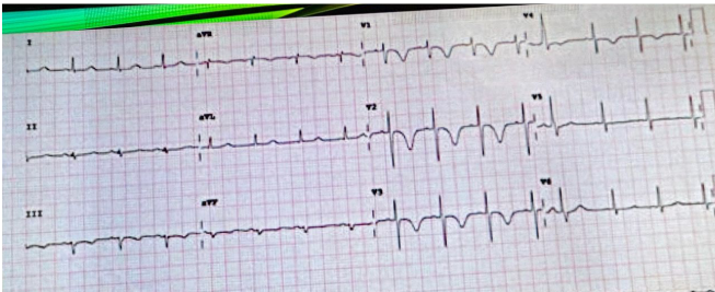 <p>Respecto a ese electrocardiograma ¿Cuál es el diagnóstico electrocardiográfico?</p>