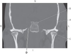 <p>Which line points to the temporal bone?</p>