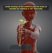 <p>Forearm resting on table, Wrist hyperextended (fingers pulled back), Hand slightly rotated toward the radius to avoid superimposition</p><p></p><p>25–30° toward the palm (toward the elbow).</p><p>CR enters 1 inch distal to the base of the 3rd metacarpal.</p>