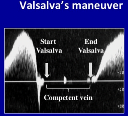 <p>What is occurring during the Valsalva Maneuver?</p>