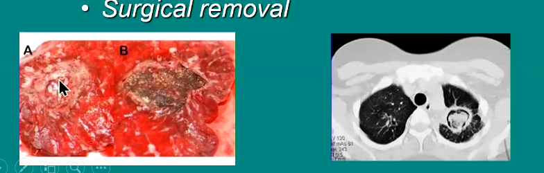 <ol><li><p><strong><em><mark data-color="green" style="background-color: green; color: inherit">Prolonged antifungal therapy</mark></em></strong></p></li><li><p>Surgical removal</p></li></ol><p></p>