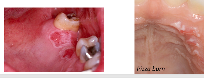 <p>-acute, heat-induced damage to oral mucosa: tender/sensitive, may be erythematous or covered by white/gray film</p><p>-resolves over 2-3 weeks</p>