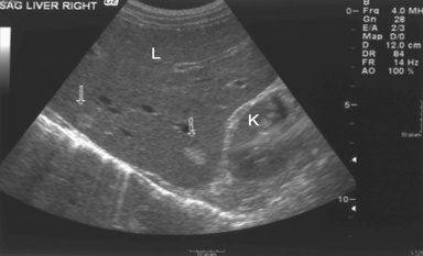 What is the kidney’s echogenicity to the liver?
