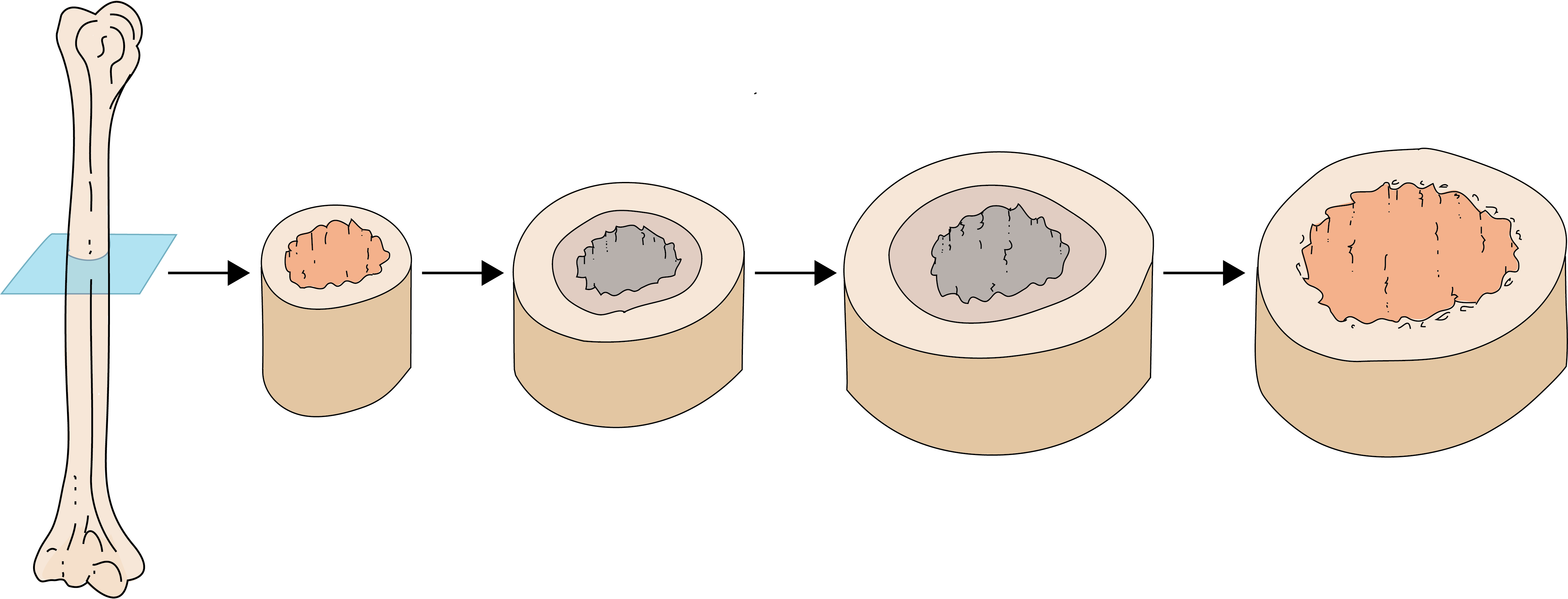 <p>Appositional growth is how bones <strong>increase in diameter or thickness</strong> through a coordinated process:</p>
<ul>
<li><strong>Deposition</strong>: Osteoblasts in the periosteum deposit new bone matrix on the external surface.</li>
<li><strong>Resorption</strong>: Simultaneously, osteoclasts on the endosteal surface resorb bone from the inner surface, enlarging the medullary cavity without making the bone too heavy.</li>
</ul>
<!-- -->