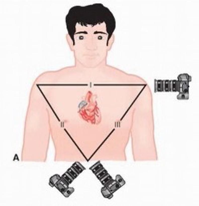 <p>I- pos electrode on L shoulder, neg electrode on R shoulder</p><p>II- pos electrode on L foot, neg electrode on R shoulder</p><p>III- pos electrode on L foot, neg electrode on L shoulder</p>
