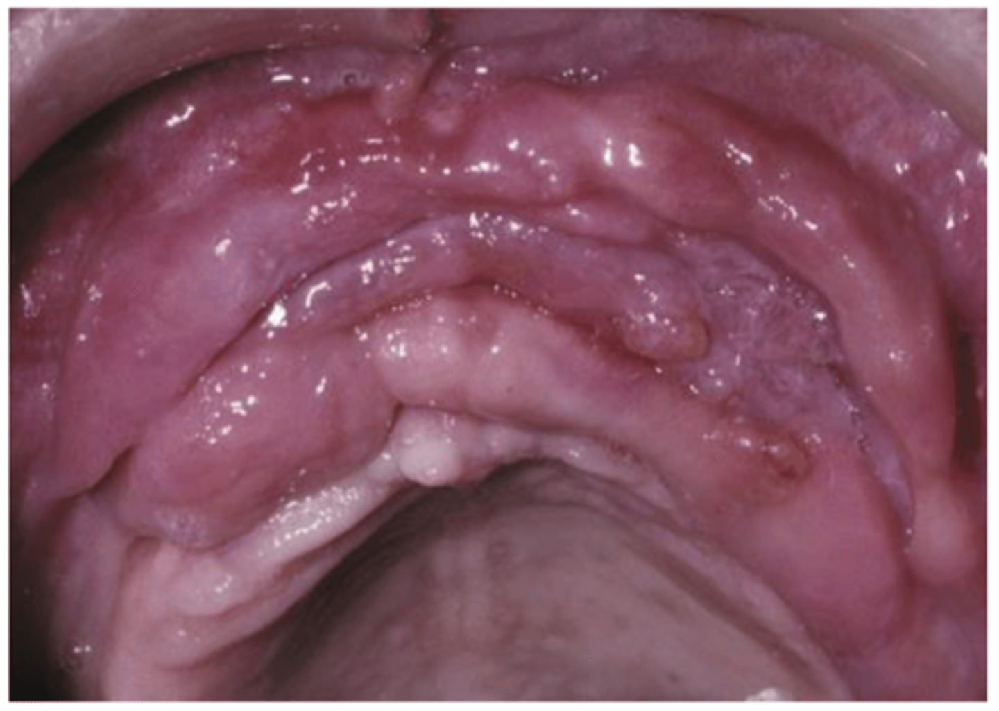 <p>• Found in the vestibules</p><p>• Redundant folds</p><p>• Rubbery</p><p>• May be ulcerated</p><p>• Overgrowth of tissue along the</p><p>border of a denture</p>
