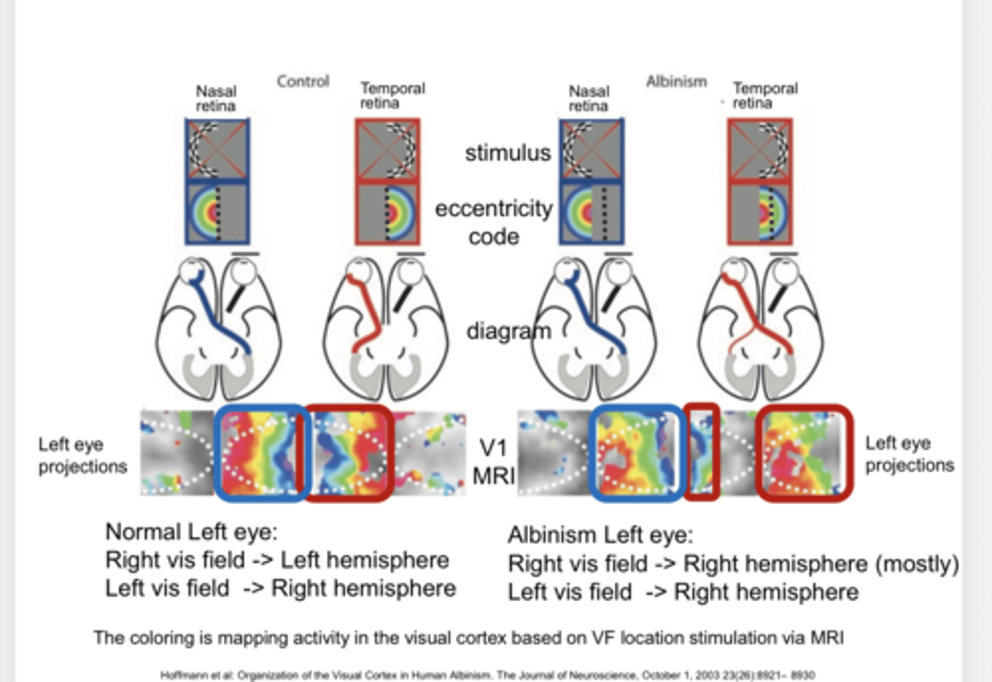 <p>In an albinism left eye, the left visual field will project to what hemisphere of the occipital lobe?</p>