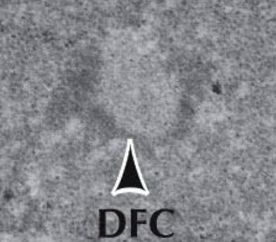 <p>Dwane fibrillation component </p>