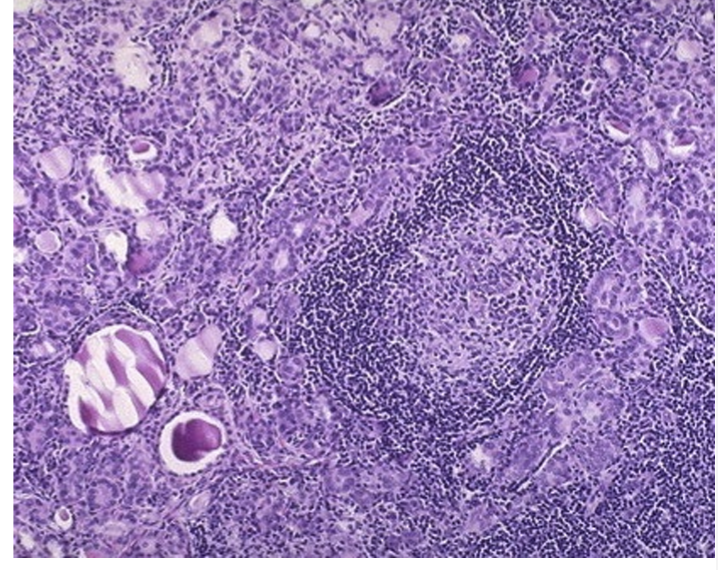 <p>What disease is this </p>