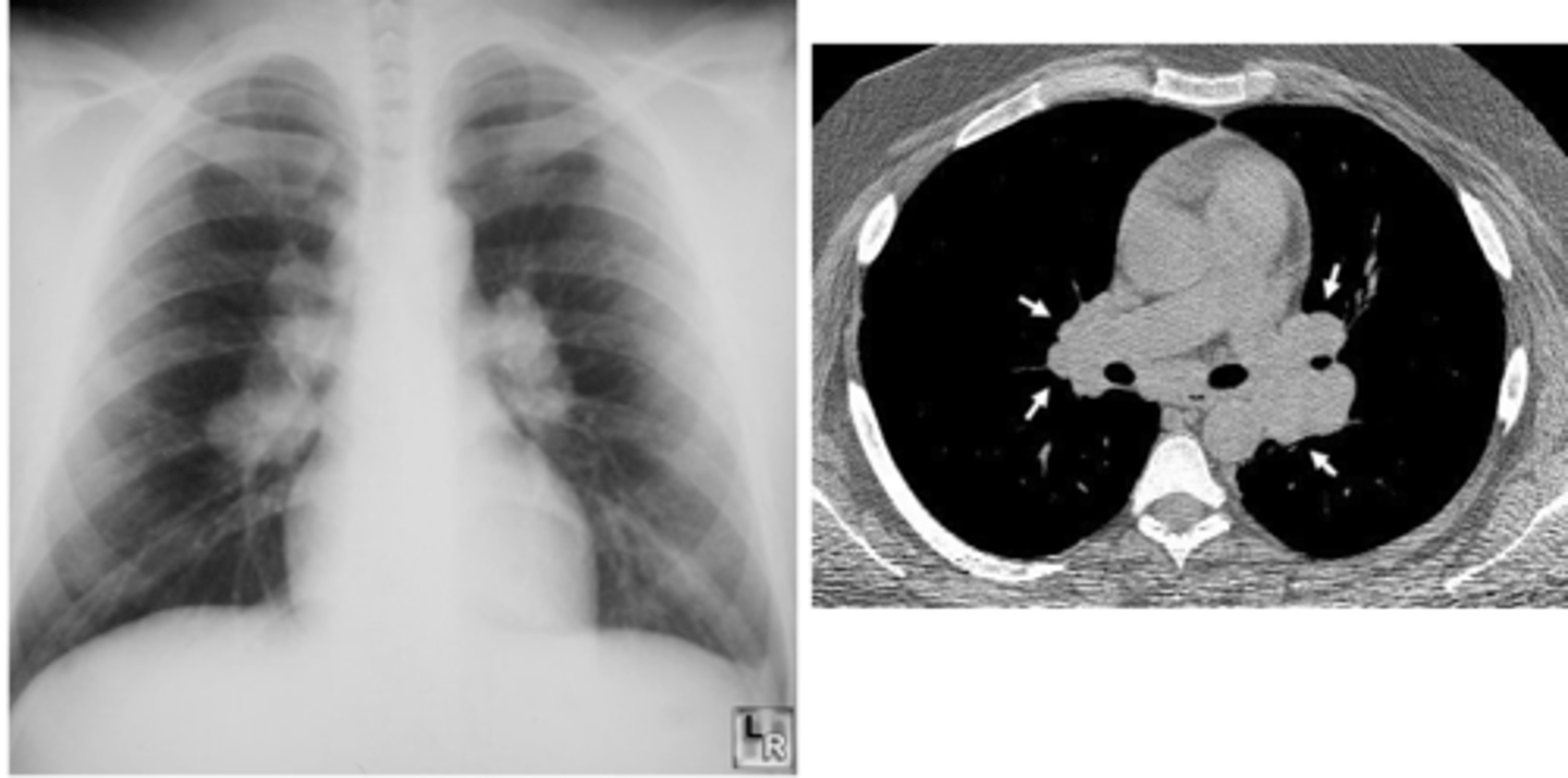 <p>sarcoidosis! <br>stage 1 usually</p>