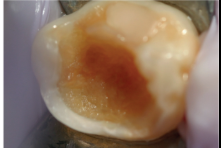 <p>open cavity </p><p>remove overhang enamel </p><p>show parent how to get toothbrush to clean </p><p>make the cavity a dish shape</p>