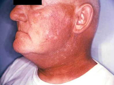 <p>What kind of antineoplastic treatment is this?</p>