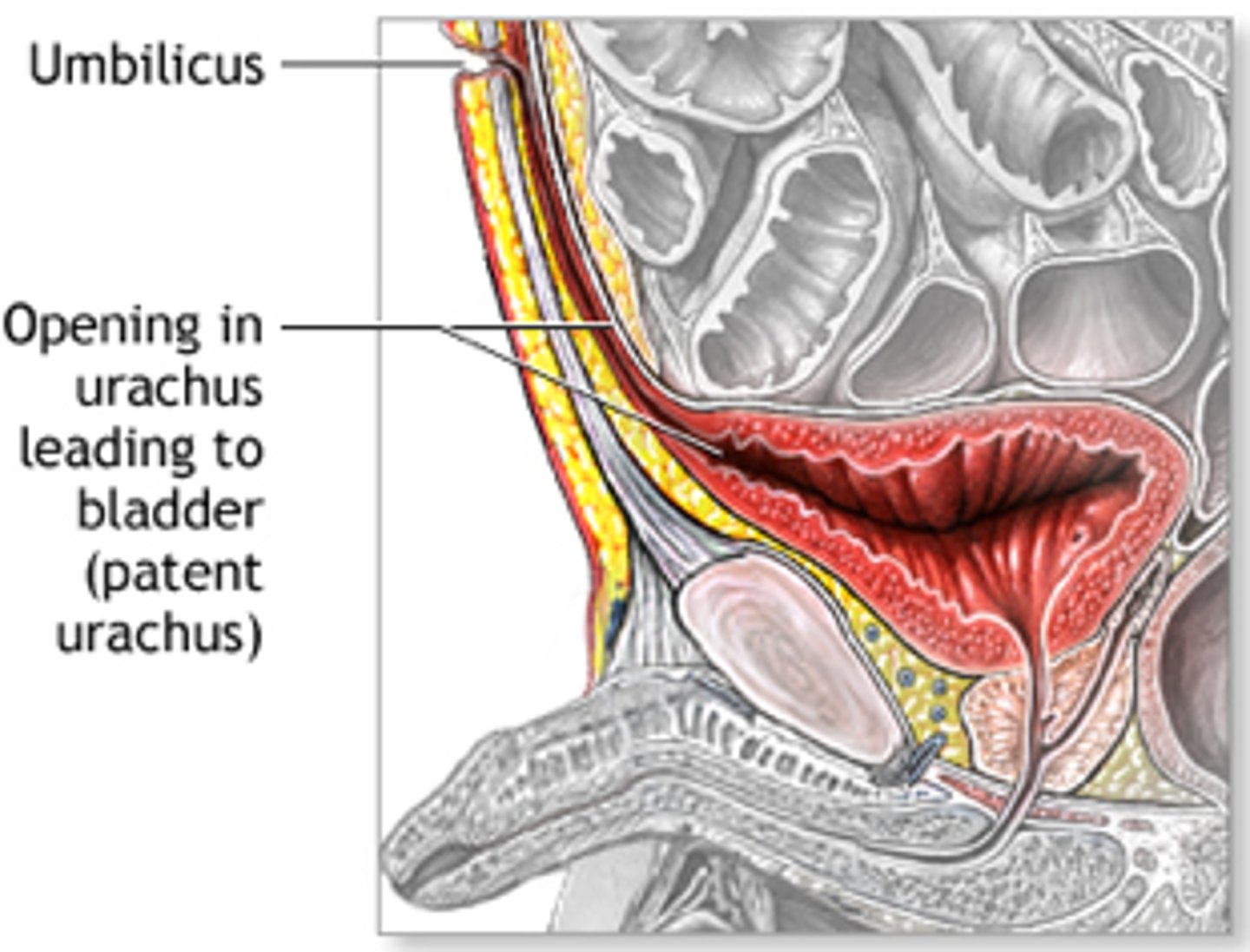 <p>a tubular structure that is a remnant of embryonic development, which extends from the umbilicus to the apex of the bladder (the structure that is the communication between the bladder and umbilicus)</p>