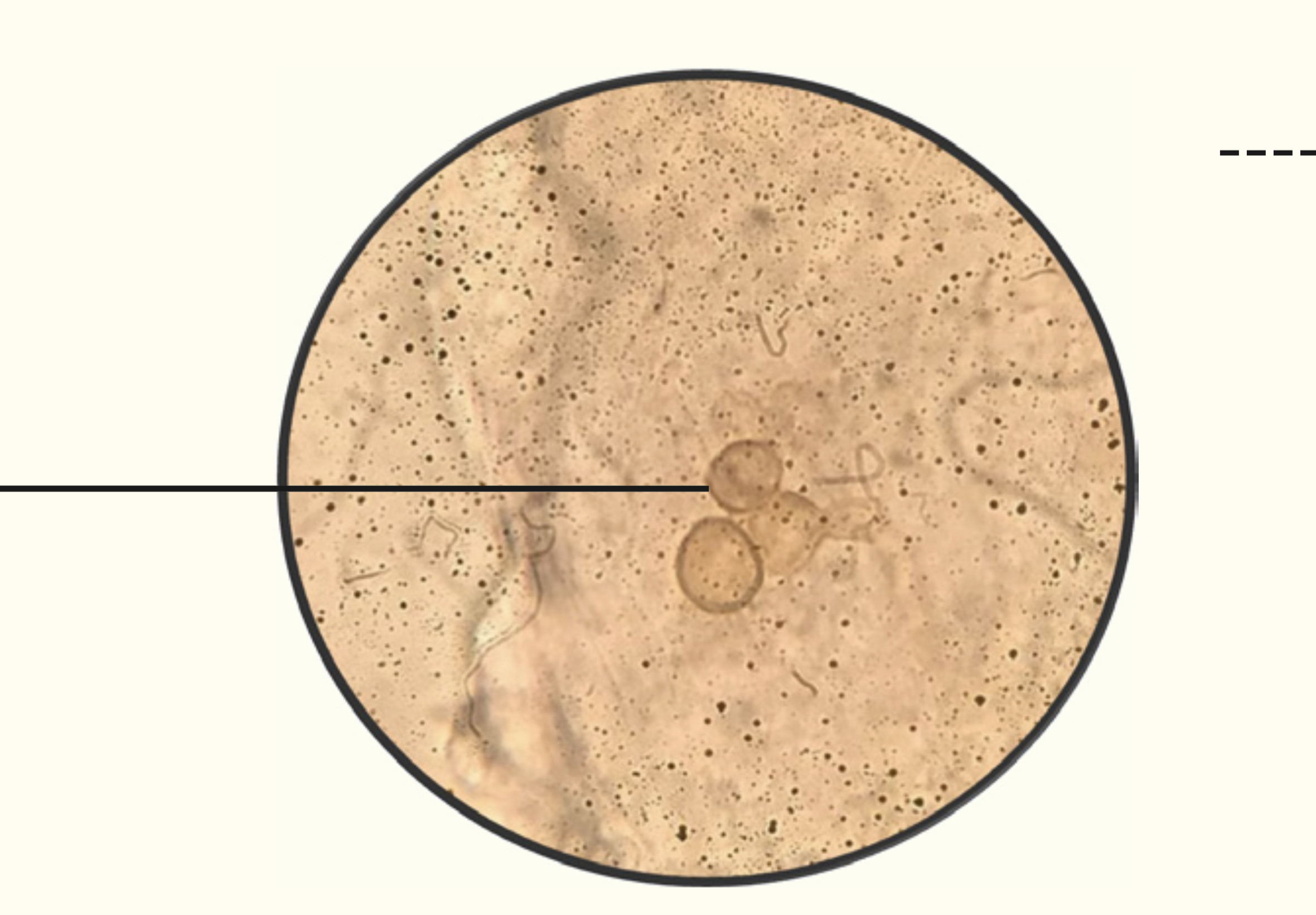 <p>Chromoblastomycosis</p>