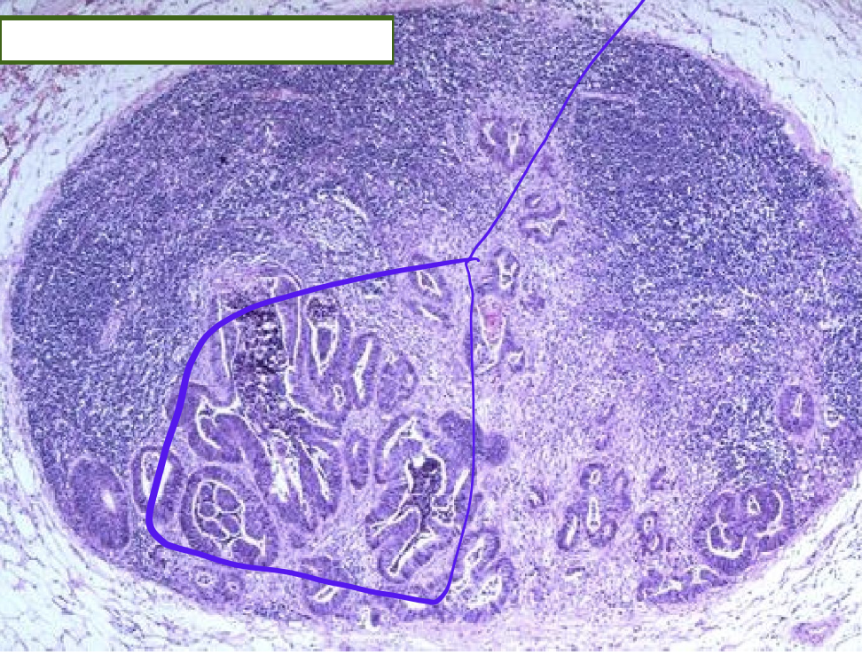 <p>Identify the <strong>organ</strong> and the <strong>diagnosis</strong> in this format: <em>diagnosis, organ</em></p>