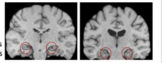 <ul><li><p>cases of Jon, Beth and Kate with bilateral hippocampal damage from birth (hypoxia due to complications in labour)</p></li><li><p>amnesic: poor at verbal and non-verbal learning</p></li><li><p>IQ, academic attainment, reading comprehension, working memory, semantic memory all developed normally</p></li><li><p>44% reduction in hippocampus relative to controls</p></li></ul><p></p>