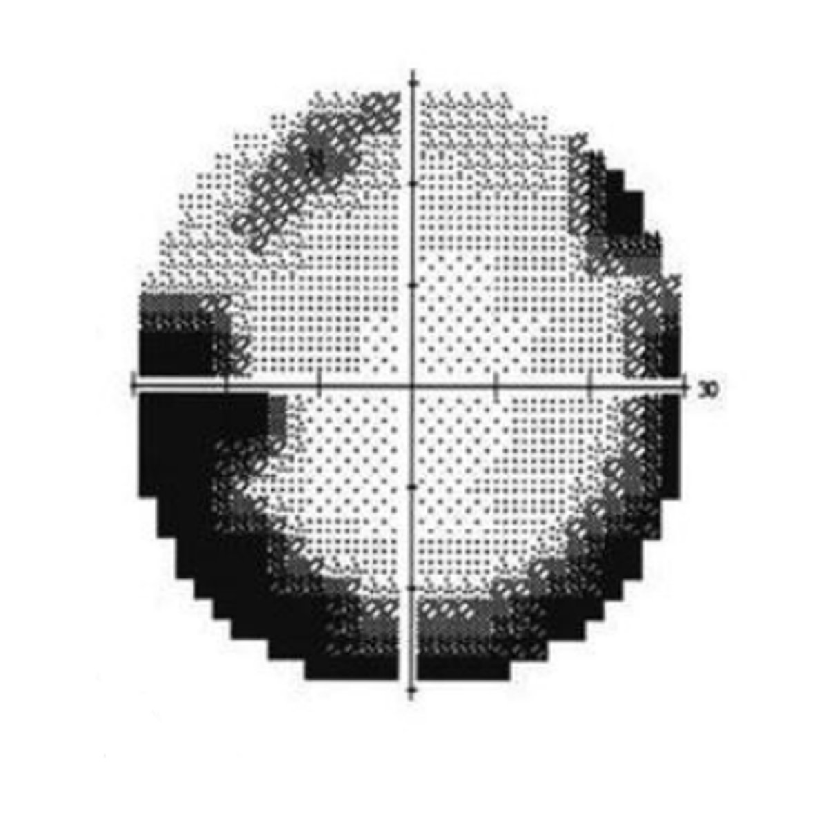 <p>If the trial lens is too far from the eye, it will produce a visual field artifact in the shape of a...</p>