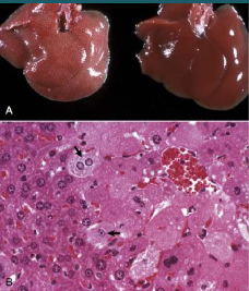 <p>How is this liver reacting to injury? Describe the pathophysiology</p>