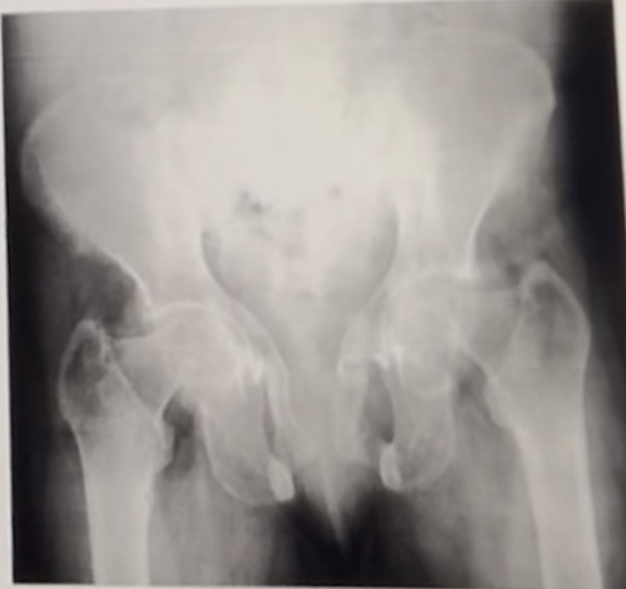 <p>osteomalacia, secondary hyperparathyroidism</p><p>3 multiple choice options</p>