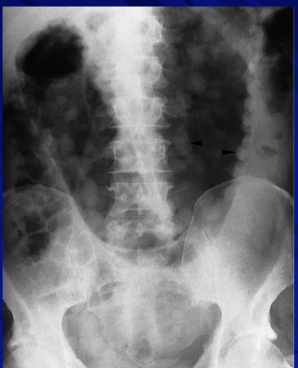 <p>Look for presence of pseudo-polyps</p>
